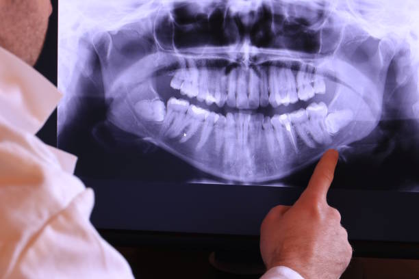 Best Emergency Tooth Extraction in Markle, IN