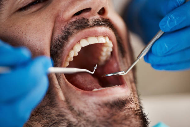 Best Emergency Treatment for Dental Infections or Abscesses in Markle, IN